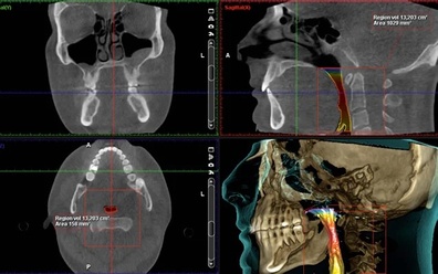 3D Imaging Planmeca Cone Beam CT